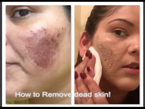 What's the best way to cleanse your face? How to remove dead skin after Micro needling| Vlog Day 4 ...