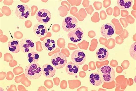 Chronic Neutrophilic Leukemia The Peripheral Blood Smear Shows An