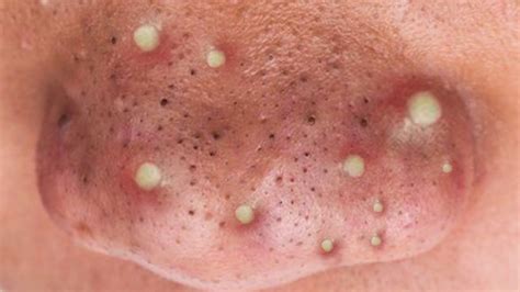 Top Ten Blackheads Pimples And Staph Infections Youtube