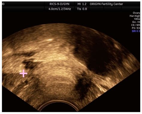 Diagnostics Free Full Text Transvaginal Ultrasound As A First Line
