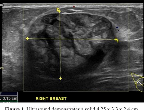 Figure 1 From Malignant Phyllodes Tumor Of The Breast Presentation Of