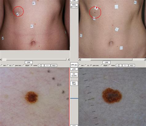 Ulceration is a breakdown of skin on melanoma. What is melanoma? | Melanoma Blog