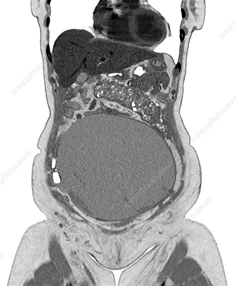 Ovarian Cancer Ct Scan Stock Image C0509699 Science Photo Library
