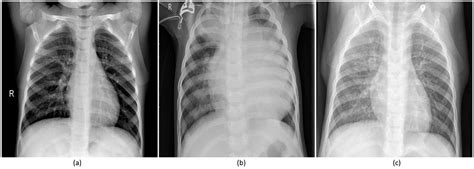 Darker colors indicate less dense material, and lighter colors indicate more it is frequently used to aid the diagnosis of acute and chronic conditions in the lungs. Booklet: Normal Pneumonia Normal Xray Report Normal ...