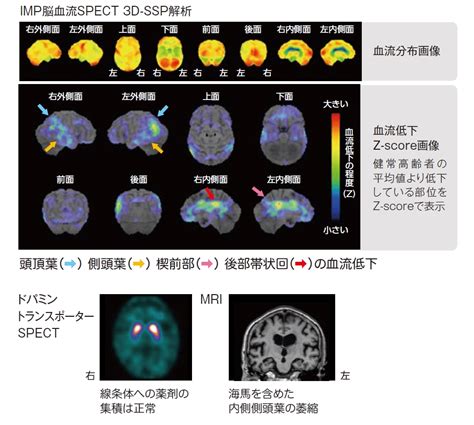 Include (or exclude) self posts. 認知症鑑別診断のための脳SPECT画像所見 | 日本メジフィジックス ...