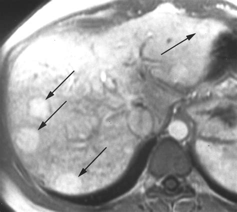 Large Regenerative Nodules In Budd Chiari Syndrome And Other Vascular