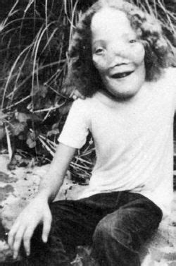 Roy lee rocky dennis was an american boy who suffered from the rare sclerotic bone disorder, craniodiaphyseal dysplasia, which caused his death at the age of 16. Roy Lee "Rocky" Dennis (1961-1978) - Find A Grave Memorial