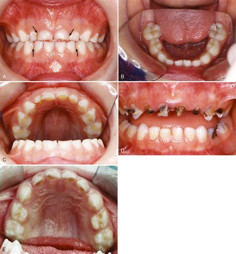 The most common among all types of lesions of the oral cavity received caries. 10: Dental Caries in the Child and Adolescent | Pocket ...