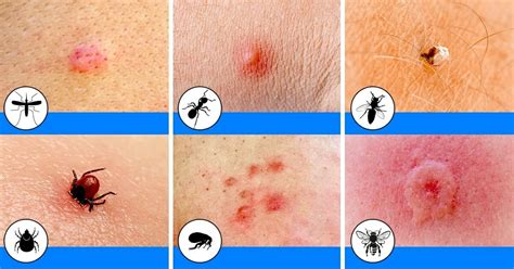 Insect Bites Stings That You Should Learn To Recognize This Summer