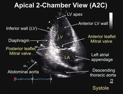 Apical 2 Chamber View Tee Cardiac Sonography Diagnostic Medical