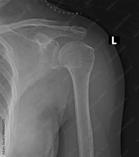 Proximal Humerus Fracture Orthobullets