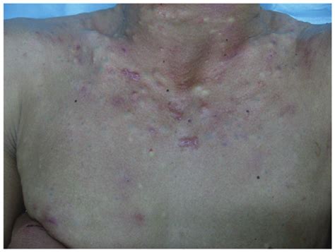 Steatocystoma Multiplex Lesions Located On The Neck And Chest Of The