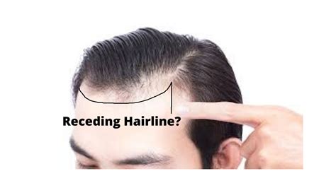 Receding Hairline Stages Signs And Treatment
