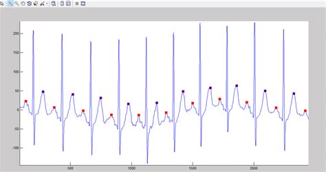 Qrs Complex Detection Result Download Scientific Diagram