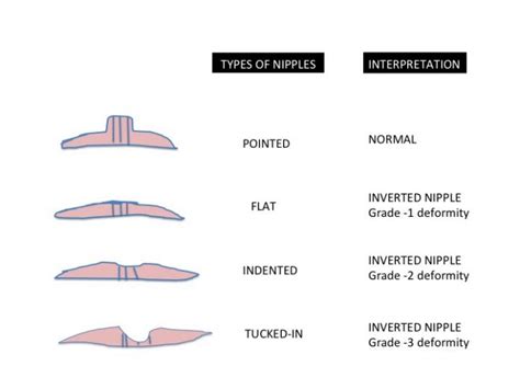 Inverted Nipples Causes Treatment And Breastfeeding Inverted Nipple