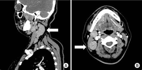 Sagittal A And Axial B Images Of Enhanced Neck Computed Tomography