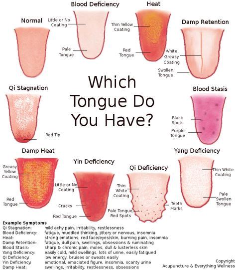 Tongues And What Acupuncturists Can Tell About Them Tongue Health Holistic Health Remedies