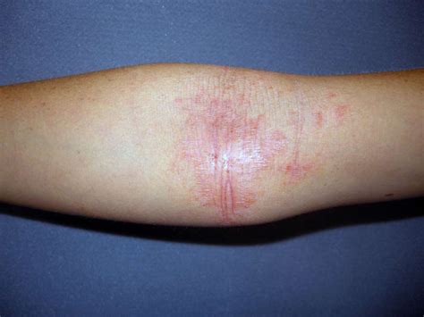 Flexural Eczema Symptoms Causes Treatment