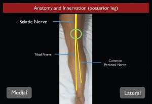 How to Perform Ultrasound-Guided Distal Sciatic Nerve Block in the