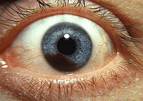Nevusfreckle In The Eye Risk Factors Of Melanoma Nevi