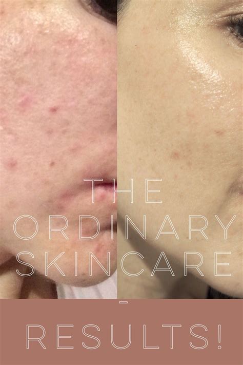 The Ordinary Results! Before and After Pictures | The ordinary skincare