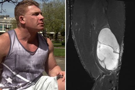 Bodybuilder Has Giant Melon Sized Tumour Removed From Leg After