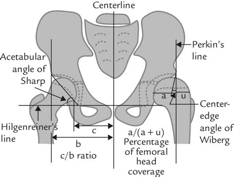 Measurements In The Anteroposterior View Of The Pelvis Used To Evaluate