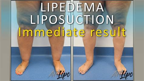 Lipedema Leg Surgery Results Lipo 360° Legs Cankles And Knees