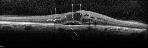 The Management Of Center Involving Diabetic Macular Edema Opth