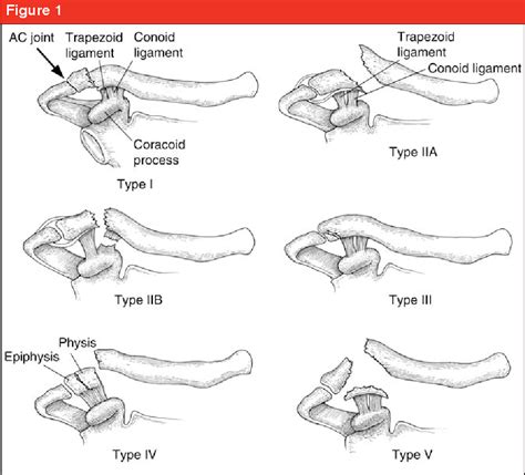 Figure 1 From Management Of Distal Clavicle Fractures Semantic Scholar