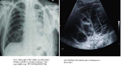 Chest Radiograph Showing Left Sided Pleural Effusion With Indwelling