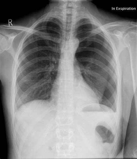 Es gibt je nach ursache drei arten eines pneumothorax: Pneumothorax