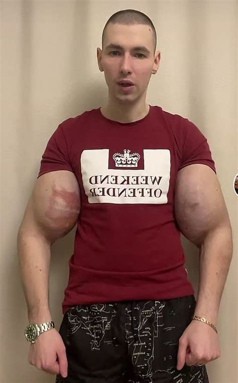 Bodybuilder Who Gained Viral Fame For Injecting Oil Inside His Arms Is Now Calling Himself Mr