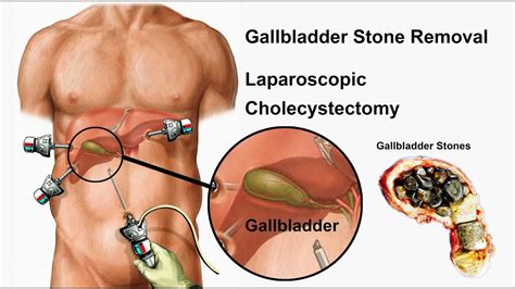 Gallbladder Stone Removal Surgery Laparoscopic Cholecystectomy