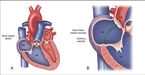 Long Term Complications After Congenital Heart Defect Repair Off The