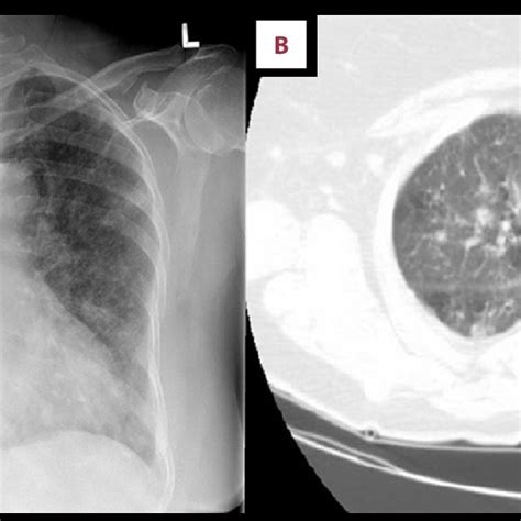 A Chest Roentgenogram Showing With Bilateral Infiltrates B Axial