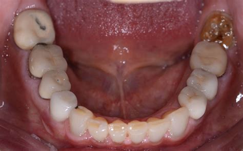 Full Mouth Restoration Glendale Az Dentist Dr Lee Ann Brady