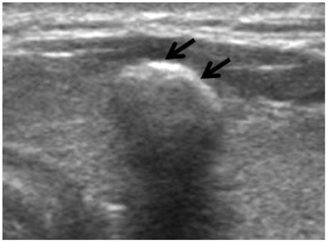 Us Findings Of Benign Thyroid Nodule With Macrocalcification