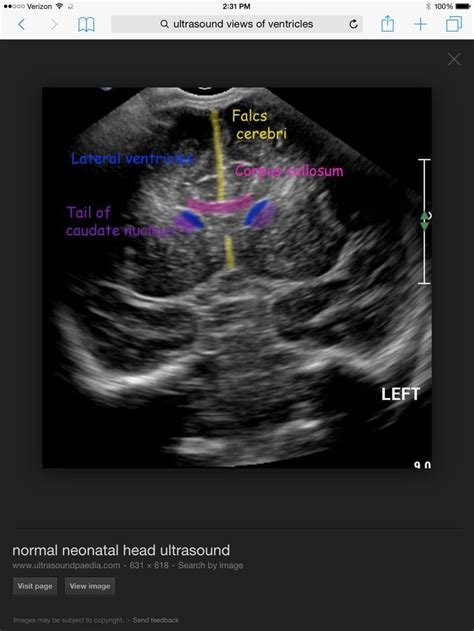 Fetal Head Ultrasound Diagnostic Medical Sonography Medical Ultrasound