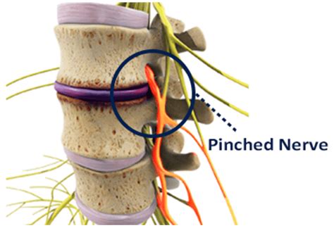 How To Combat A Pinched Nerve In The Neck Life In Motion Chiropractic