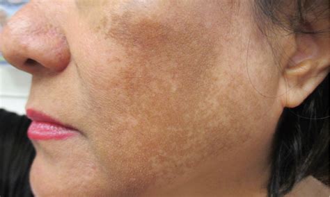 Hyperpigmented Patches On A Womans Sun Exposed Face Whats The Cause