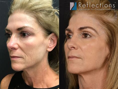 Nonsurgical Facelift With Thread Lift And Fillers Before And After Photos
