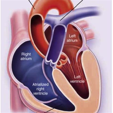 In Patients With Ebsteins Anomaly A Portion Of The Right Ventricle Is
