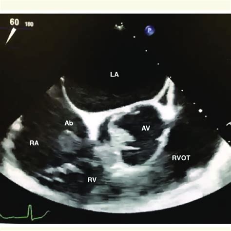 Pdf Serratia Marcescens Infective Endocarditis Complicated By Aortic