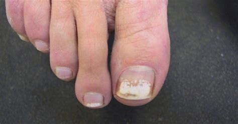 Ridges And White Spots On Toenails Design Talk