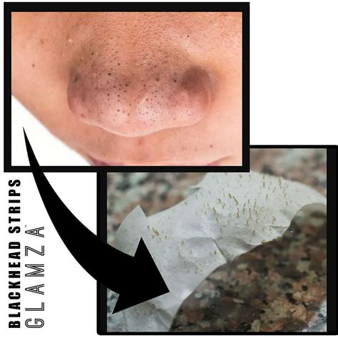 Blackhead Pore Removal Strips Nose Face Mask Deep Cleansing Treatment