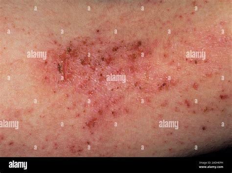 Eczema Rash On The Skin Of A 17 Year Old Girl Eczema Is Inflammation