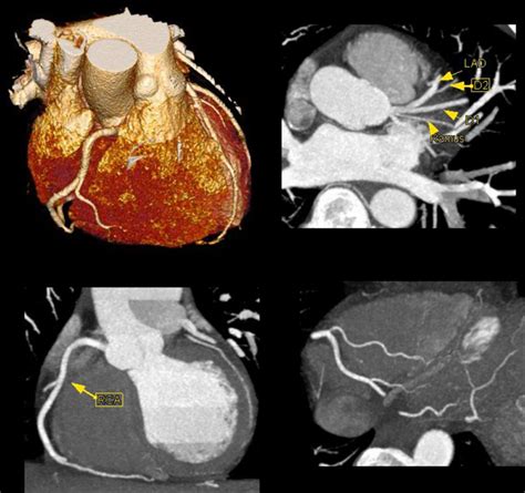 Achieving Very Low Dose Radiation Exposure In Cardiac Computed