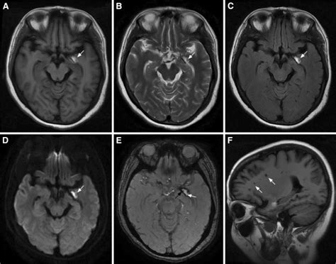 Brain Mri Obtained 5 Days Post Onset Axial T1 T2 T2 Flair And Dwi