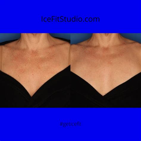 Can You Use Ipl On The Chest Intense Pulsed Light Ipl Therapy Aka